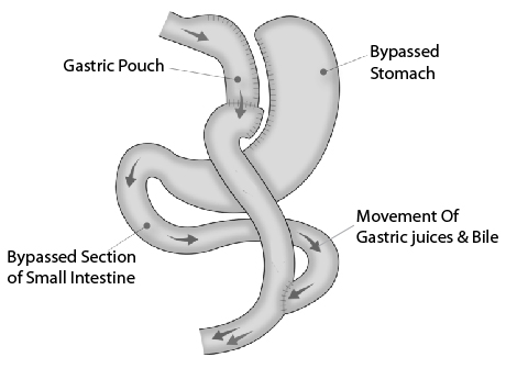 Laparoscopic Roux-en-Y Gastric Bypass