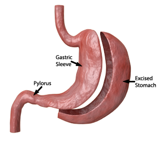 Vertical Sleeve Gastrectomy